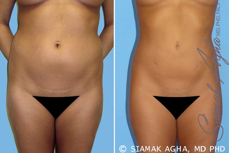 https://www.findatopdoc.com/var/fatd/storage/images/_aliases/article_main/expert/2438726-siamak-agha-mohammadi/how-does-tummy-or-abdominal-liposuction-work/10236026-2-eng-US/How-does-tummy-or-abdominal-liposuction-work.png