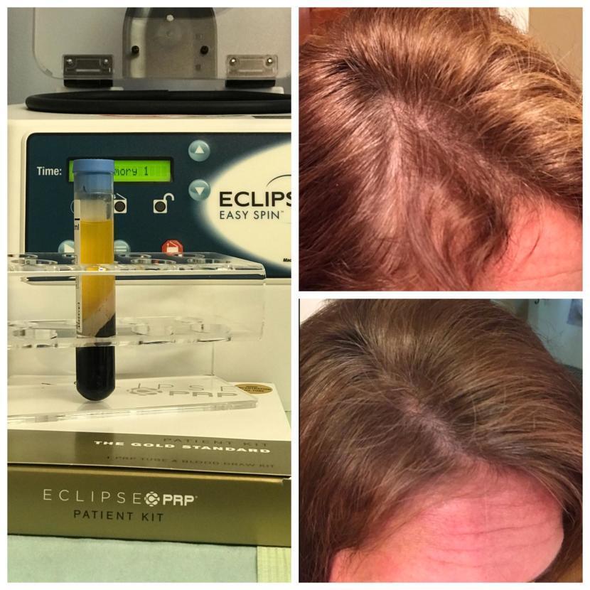 How Platelet Rich Plasma Can Change Your Hair