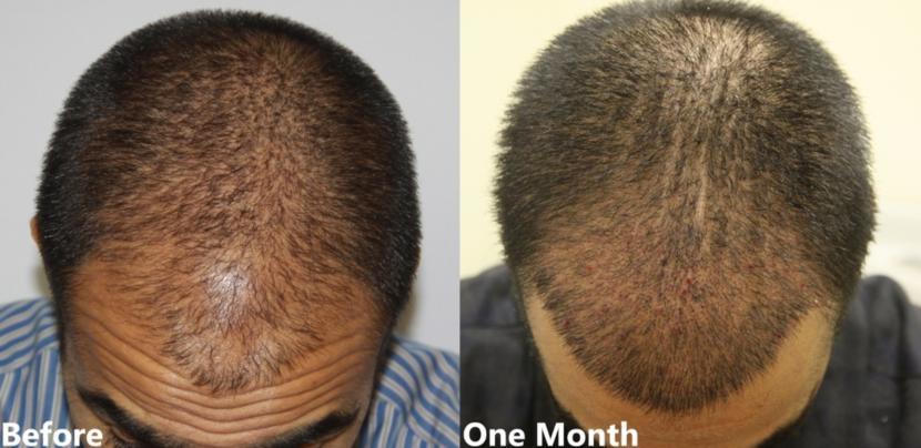 Dr. Baubac Is Seeing Faster Results with PRP