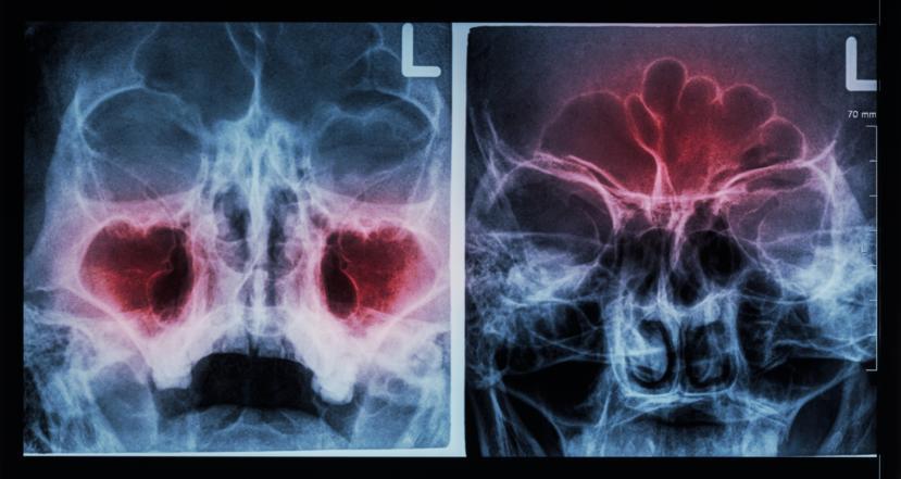 5 Tips on Living with Sinusitis