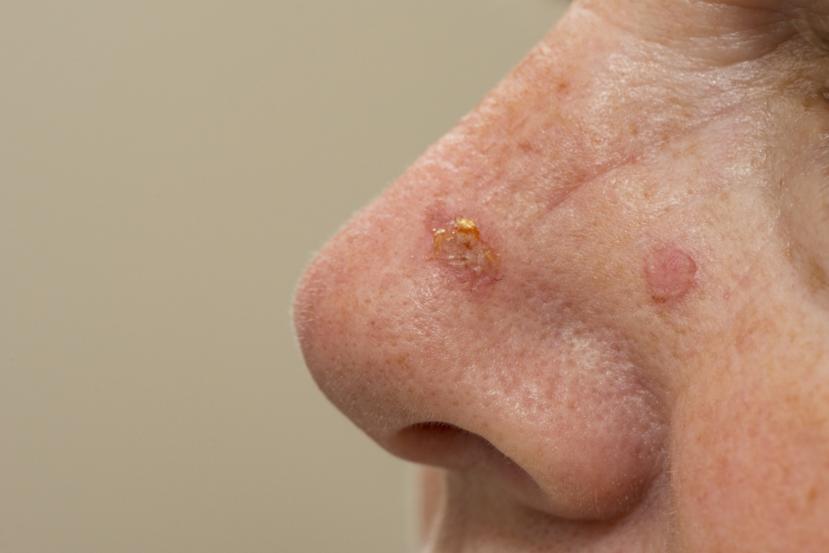 10 Actinic Keratosis Natural Cure and Home Remedies