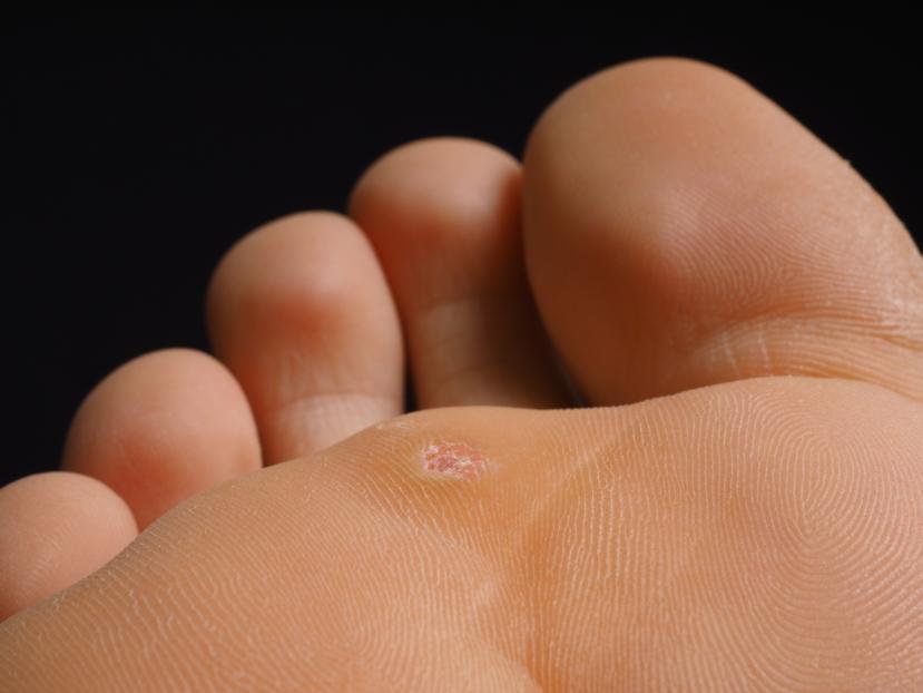 All About Plantar Warts