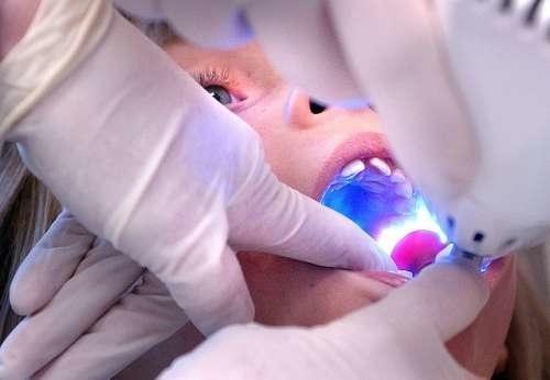Dental Sealants May Present BPA in Saliva
