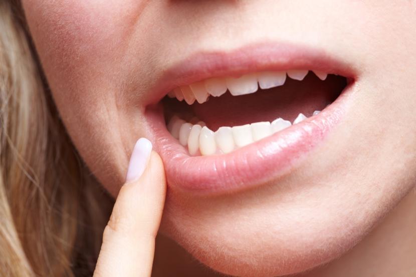 Gingivitis: Signs, Symptoms, and Treatment