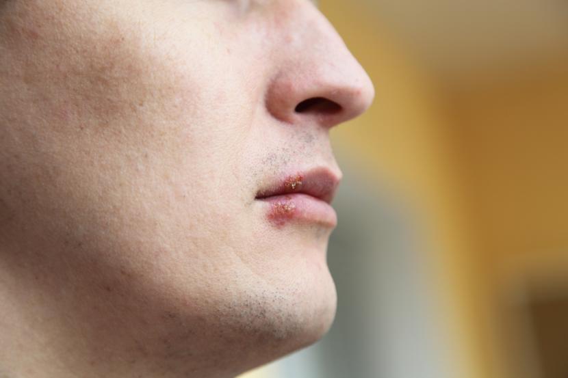 How Are Cold Sores Diagnosed?