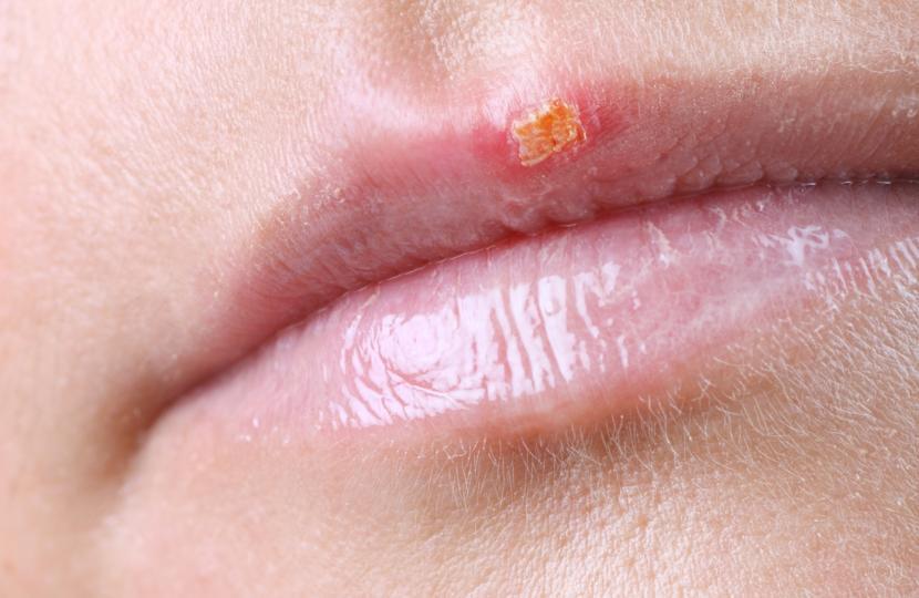 How Can I Prevent Cold Sores?