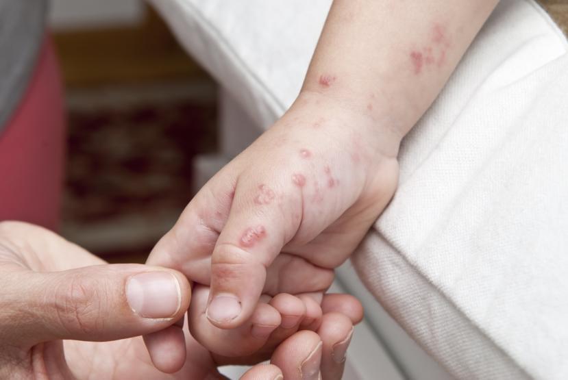 How Does Chicken Pox Spread?