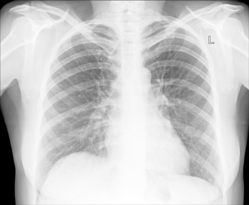 How is Bronchitis Treated?