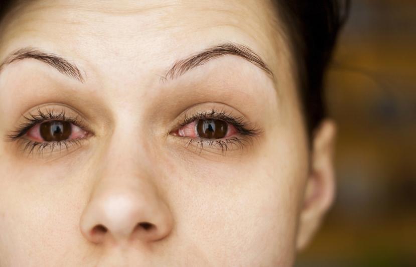 How is Conjunctivitis Contracted?
