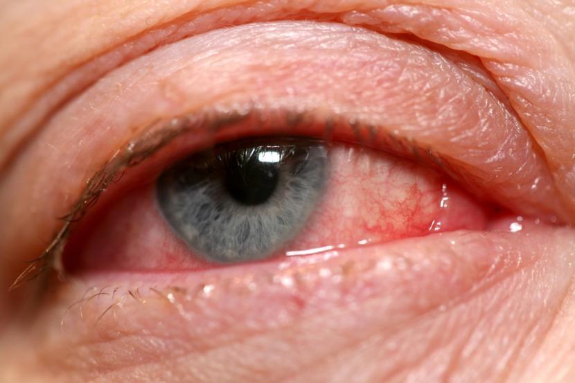 How is Conjunctivitis Diagnosed?