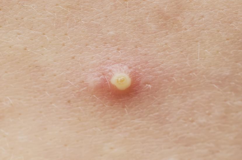 How to Get Rid of a Boil: Homeopathic Treatment and Prevention