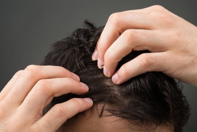 How to Get Rid of Dandruff: 15 Easy Natural Home Remedies