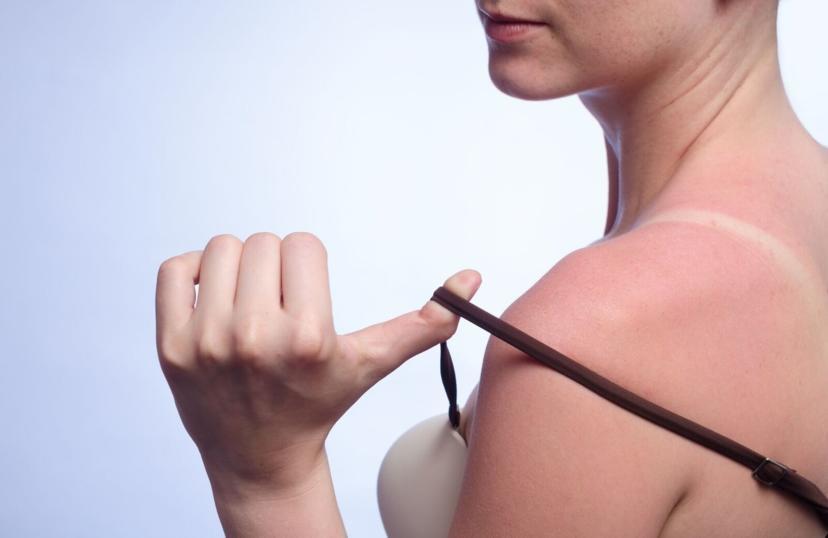 How to Treat Sun Poisoning
