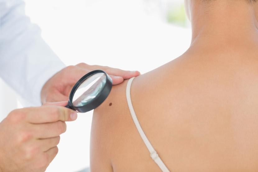 Immunotherapy for Melanoma