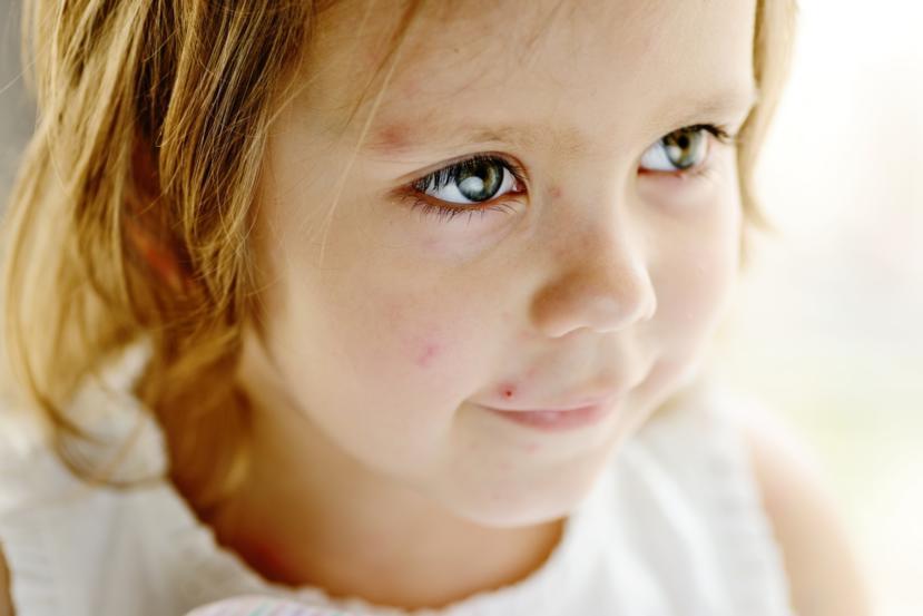 Impetigo: Causes, Symptoms, Treatment, and Home Remedies