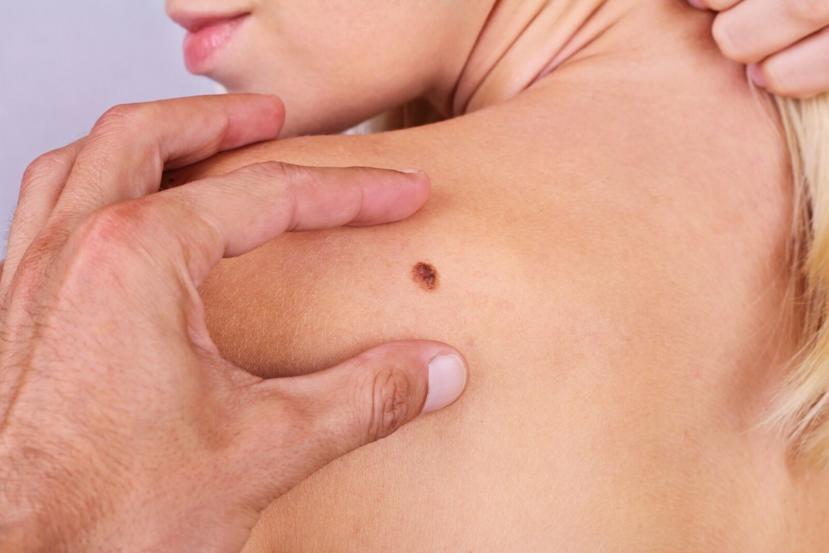Is Skin Cancer Fatal?