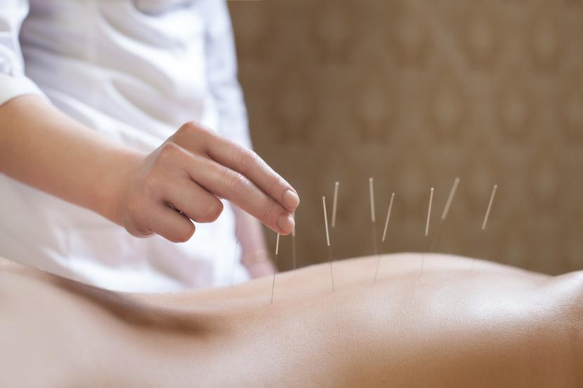 Latest Acupuncture Techniques Show Improvement in Fibromyalgia