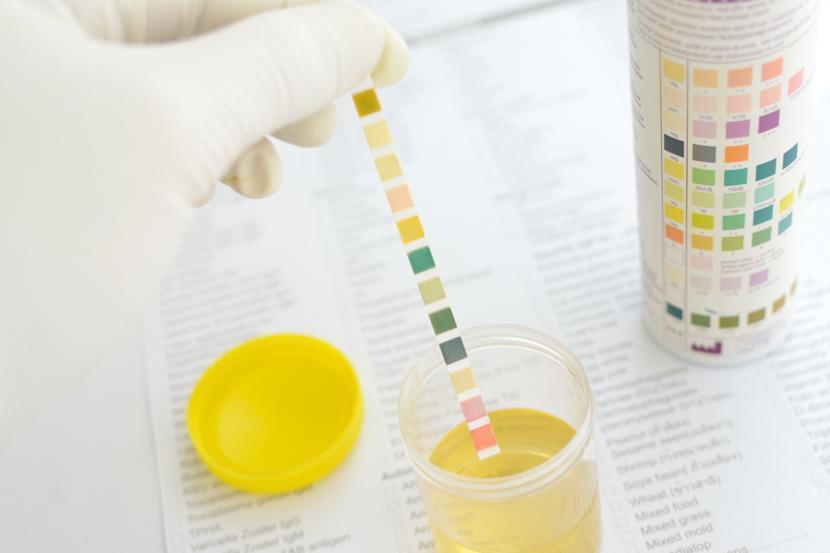Leukocytes in Urine: What Does Leukocyte Esterase in Urine Mean?