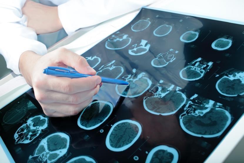 Multiple Sclerosis Treatments Are Becoming More Effective, But Are Underfunded