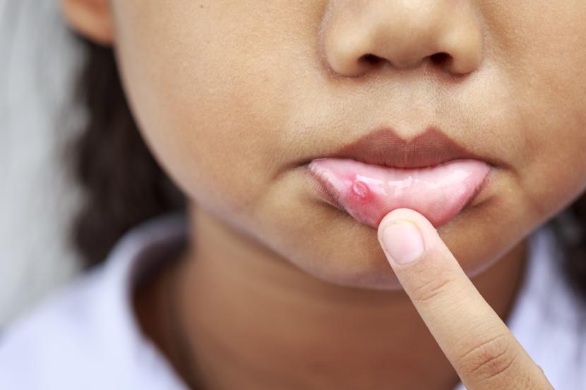 New Herbal Patch May Help to Heal Canker Sores Faster