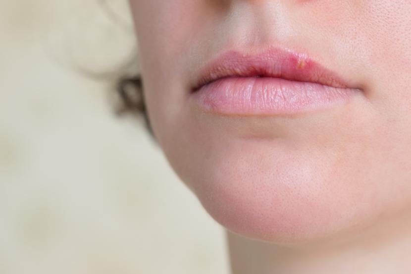 Primary Cold Sore Infection: What Is It?