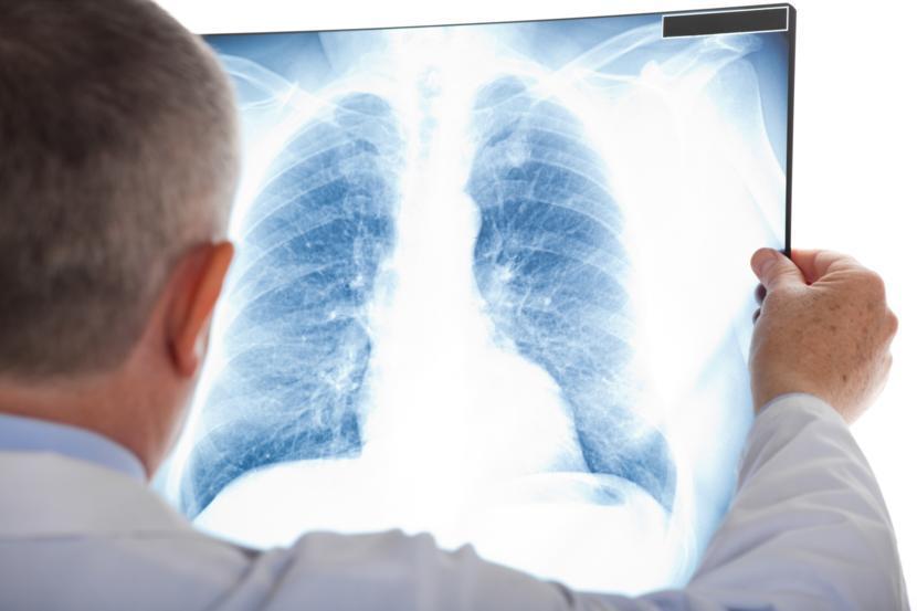 The Confusing Link Between Rheumatoid Arthritis and Lung Disorders