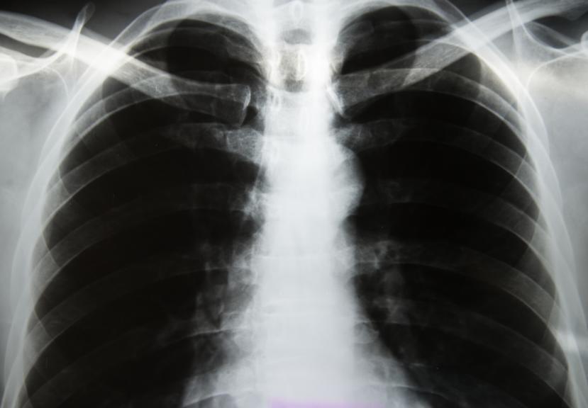 The Top 3 Myths About the Development of COPD