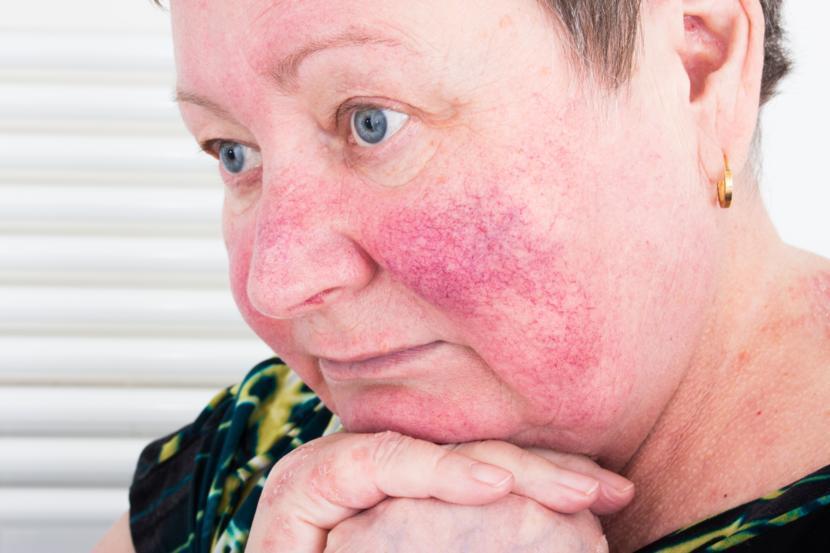 Treatments for Rosacea