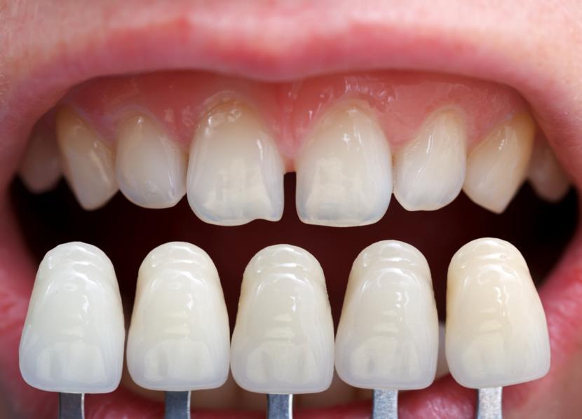 What are Dental Veneers?