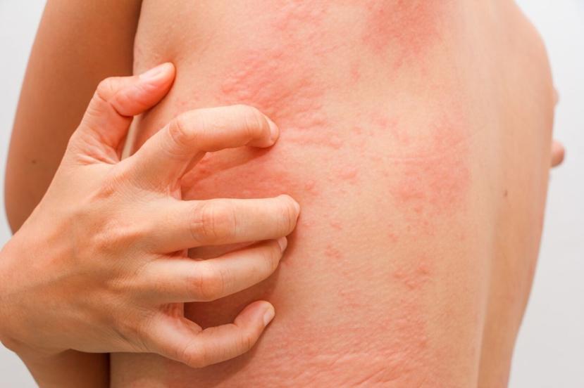 What Are Hives?