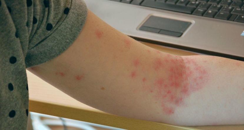 What Are Petechiae?