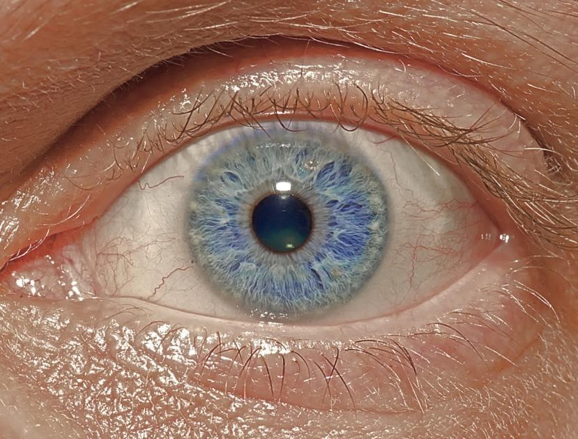 What are the Advantages and Disadvantages of LASIK Eye Surgery?