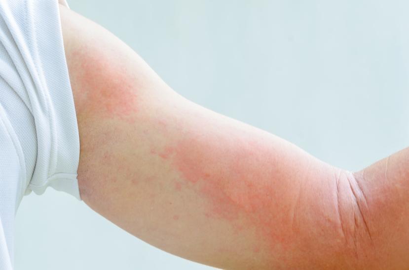 What Are the Signs and Symptoms of Hives?