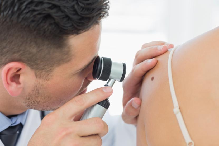 What are the Signs That Differentiate Between a Melanoma and a Mole?