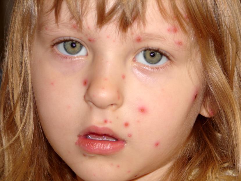 What Are the Symptoms of Chickenpox?
