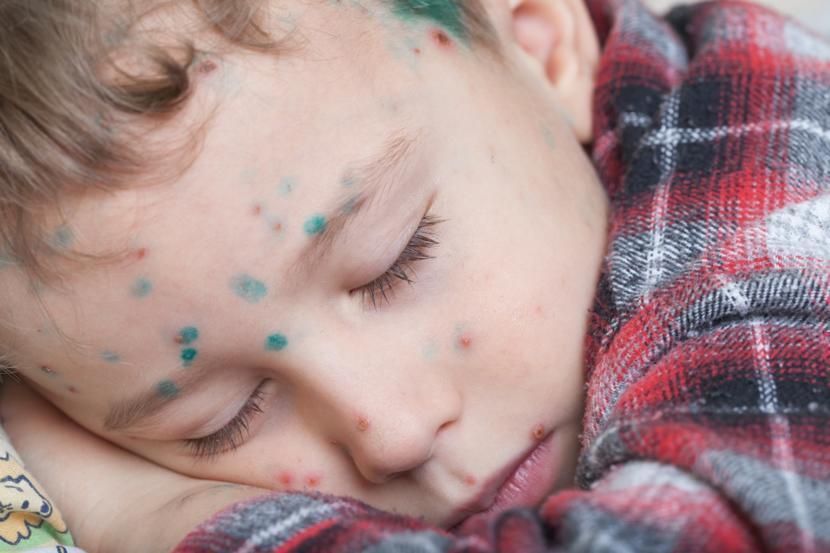 What Are the Treatment Options for Chickenpox?