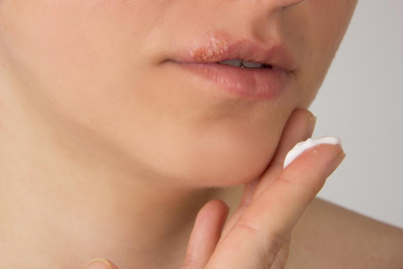 What Are the Treatments for Cold Sores?