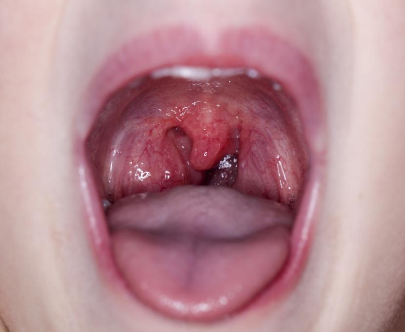What Causes a Sore Throat?