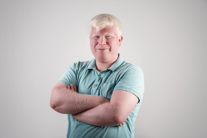 What Causes Albinism?