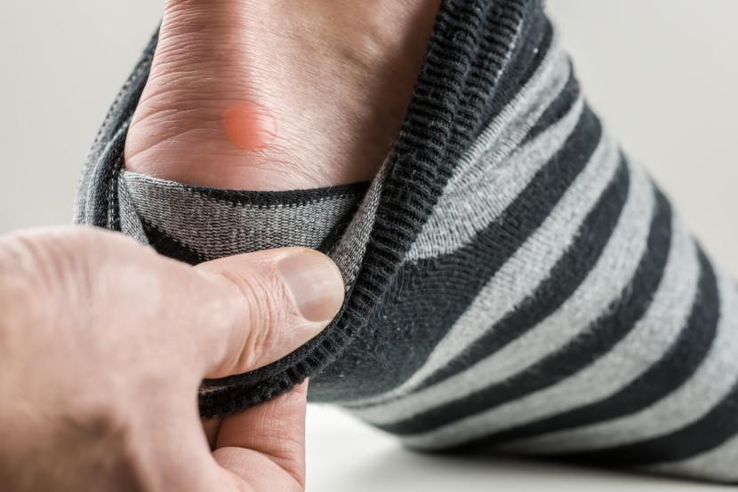 What Causes Blisters and How to Get Rid of a Blister