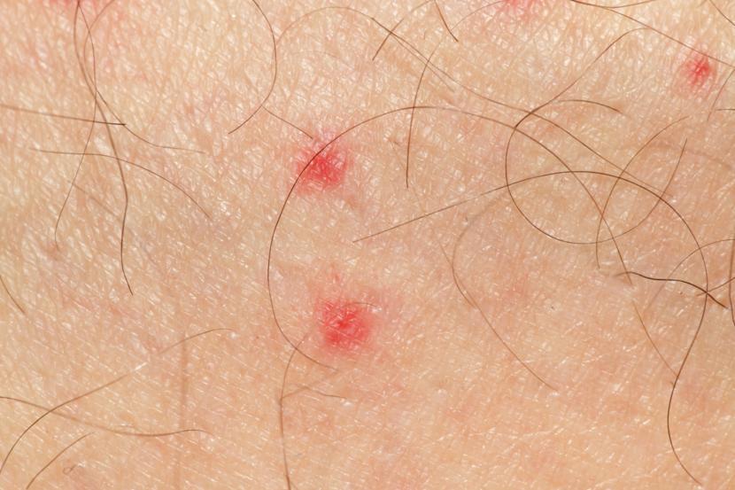 Is petechiae a symptom of leukemia?