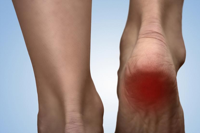 What Is a Heel Spur?