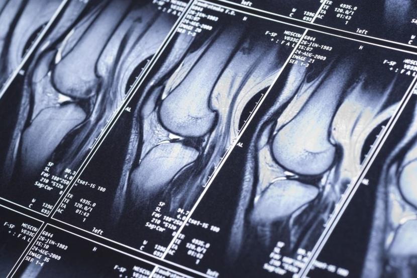 What is Bone Density?