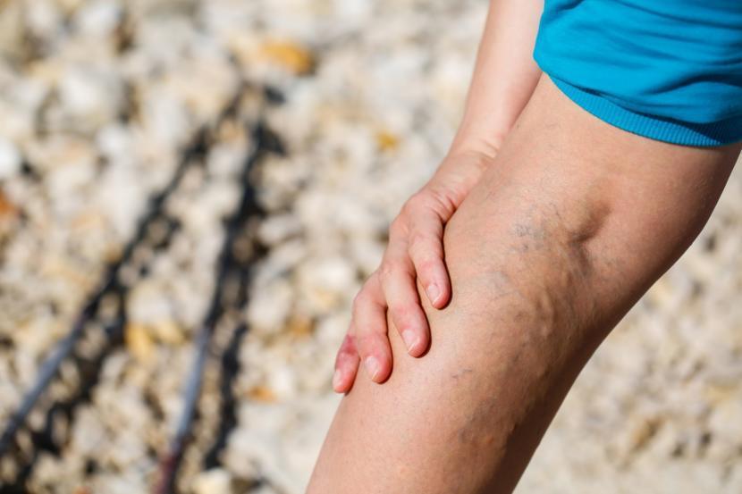 What is Ringworm?