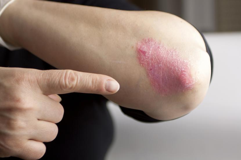What Is Seborrheic Dermatitis?