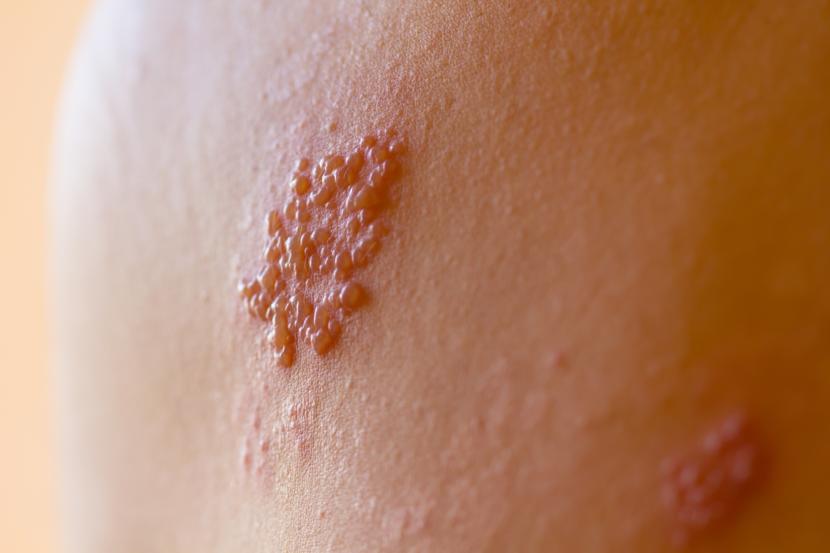 What Is Shingles?