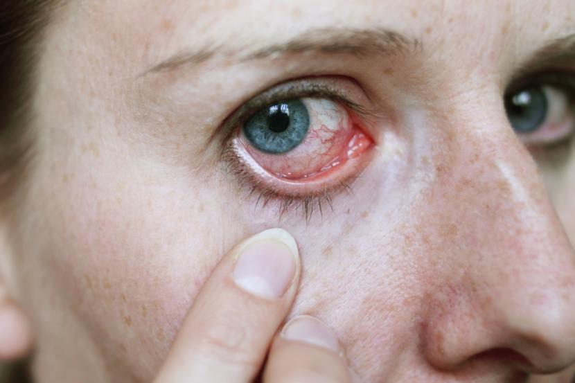 What is Viral Conjunctivitis?