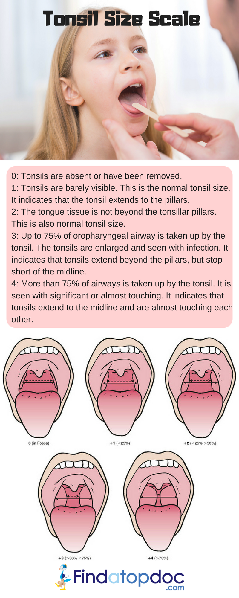 Tonsil Size Chart