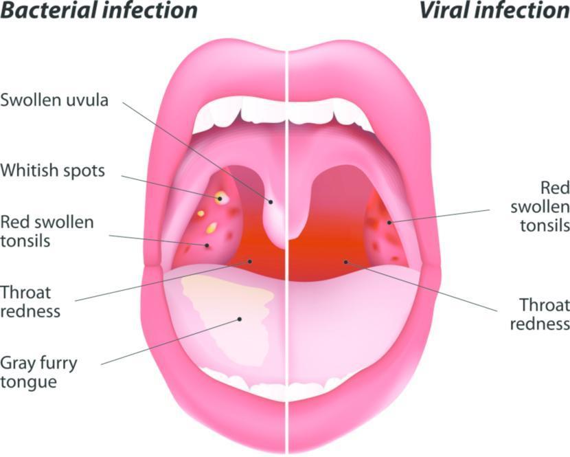 337 Images Of Viral Throat Infection Images And Pictures Myweb