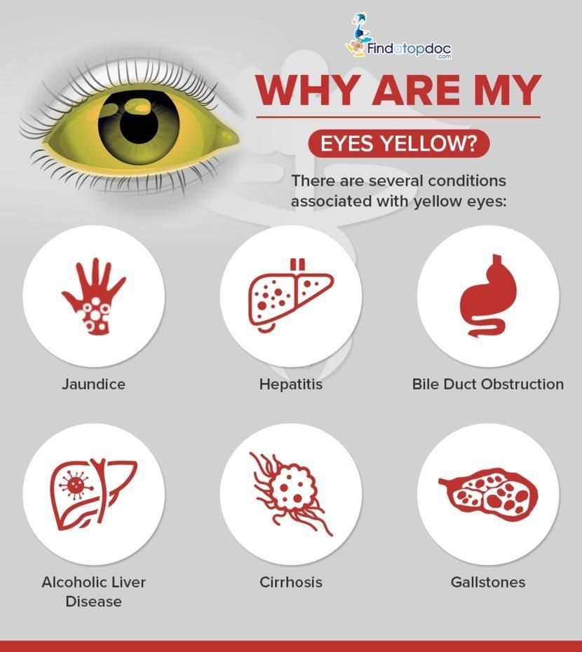 Jaundice Know The Signs And Symptoms